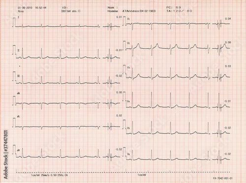 Electrocardiogramme photo