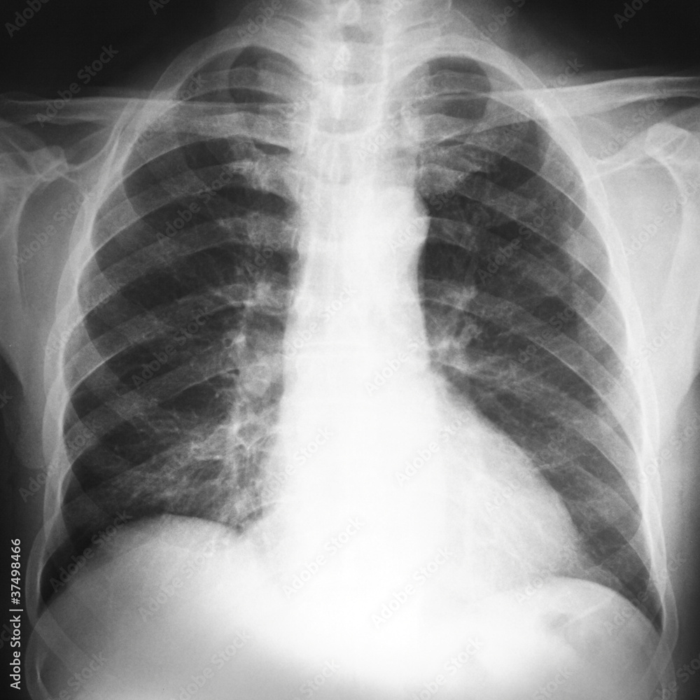 radiografia del torace