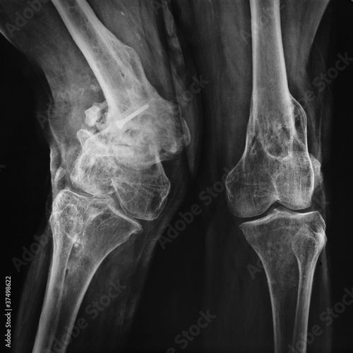 radiografia di ginocchia patologiche photo