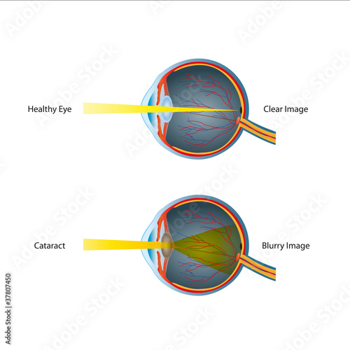 Human Eye Cataract Illustration