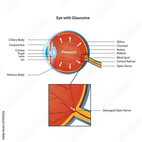eye with glaucoma eps10 vector illustration
