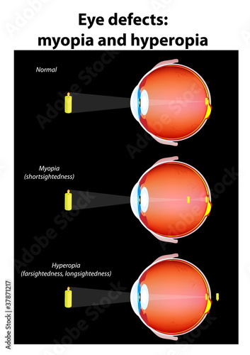 eye defects : myopia and hyperopia