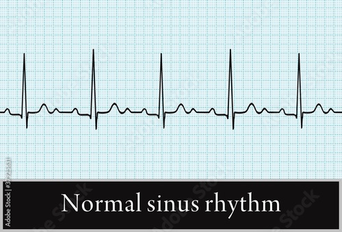 normal sinus rhythm. the vector. Information for professional