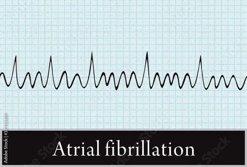 atrial fibrillation. vector. Information for Professionals