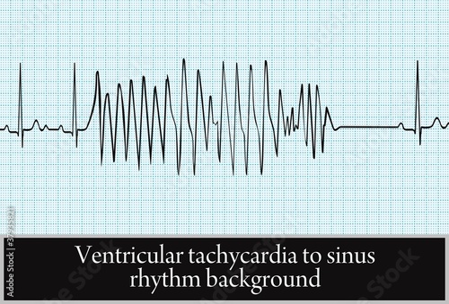 paroxysm of ventricular tachycardia. vector.