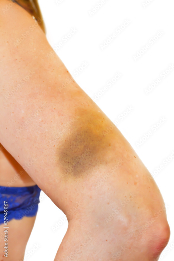 Hämatom am Oberarm einer Frau StockFoto Adobe Stock