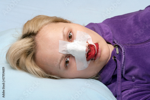 Plakat Rhinoplasty.