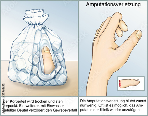 Amputationsverletzung.Erste Hilfe
