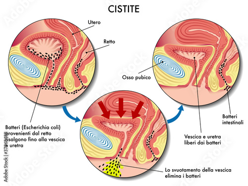 Cistite