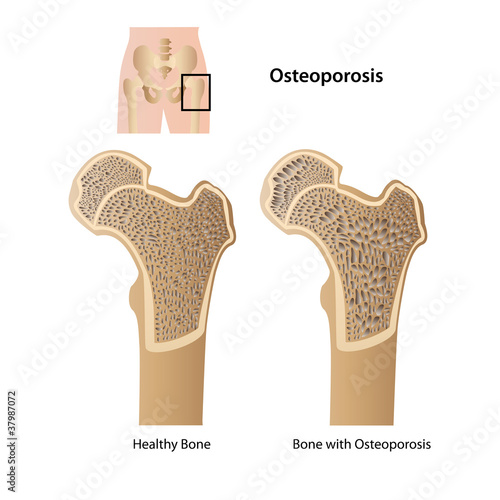 osteoporosis medical vector illustration