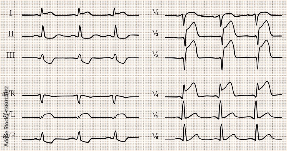 acute myocardial infarction with Q wave. ECG.detailed vector