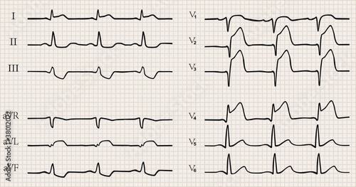 acute myocardial infarction with Q wave. ECG.detailed vector