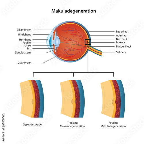 makuladegeneration vektor illustration deutsch mit beschreibung