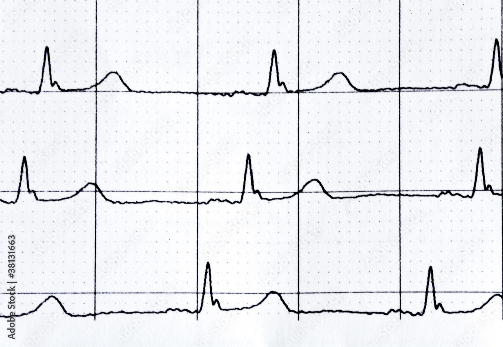 Naklejka premium heart rate in graph on a paper from the medical device