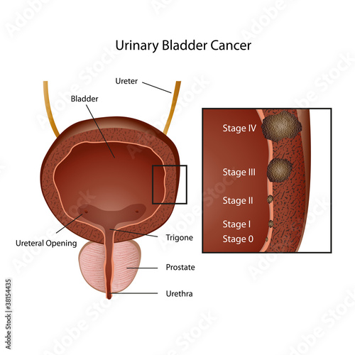 urinary bladder cancer vector illustration