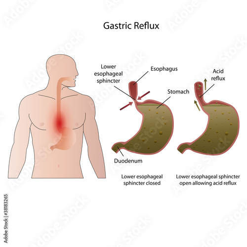 Gastroesophageal reflux disease medical vector illustration