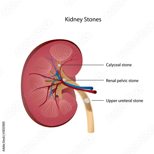 kidney stones medical vector illustration english