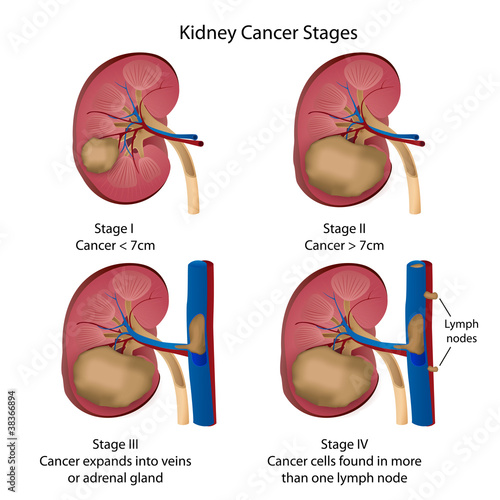 kidney cancer stages vector illustration