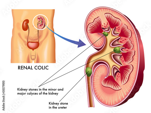 colica renale