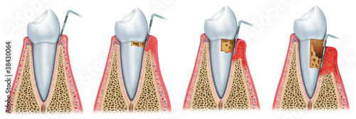Sequence of Periodontitis #38430064