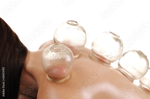 cupping massage - a young woman photo