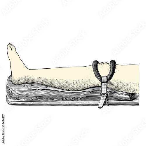 Fracture de Rotule