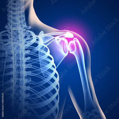 Schmerzen in der Schulter - 3D Grafik