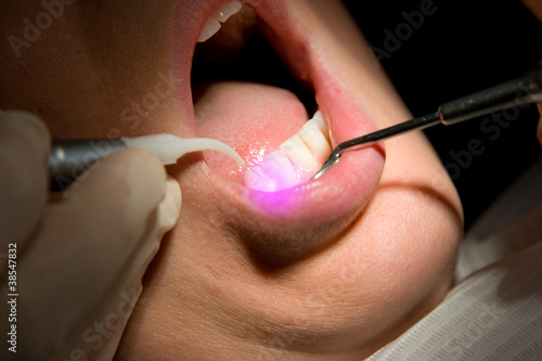 Dental Laser Zahnfleisch Zahnarzt Behandlung