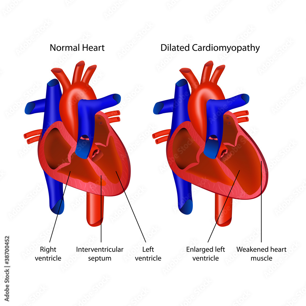 Dilated Cardiomyopathy Heart Vector Illustration Stock Vector 