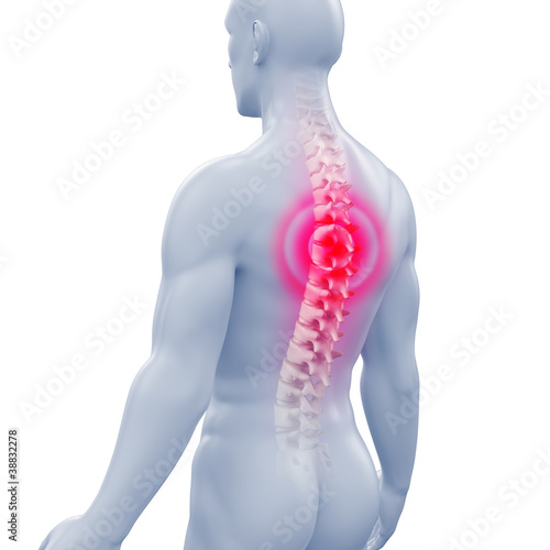 Männlicher Rücken mit Wirbelsäule - Rückenschmerzen