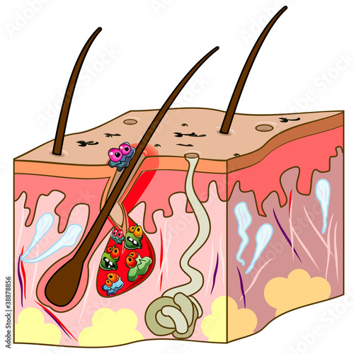 Scheme of skin with acne