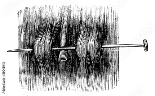 Acupressure with a single needle, vintage engraving.