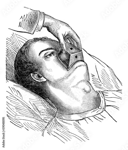 Application of a cone chloroform, vintage engraving.