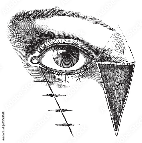 Fig. 180. Blepharoplasty by the method of Dieffembach, vintage e