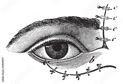 Fig. 178. Blepharoplasty by the method of Blasius, vintage engra