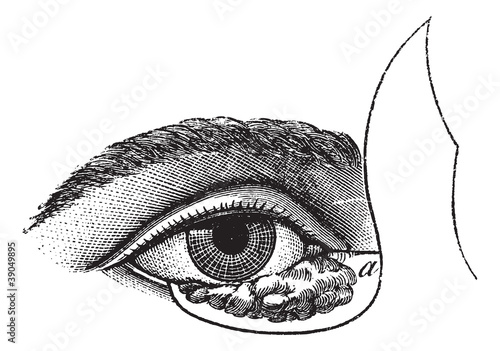 Fig. 177. Blepharoplasty by the method of Blasius, vintage engra