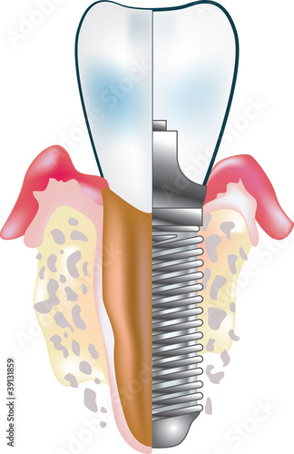 Tooth implant