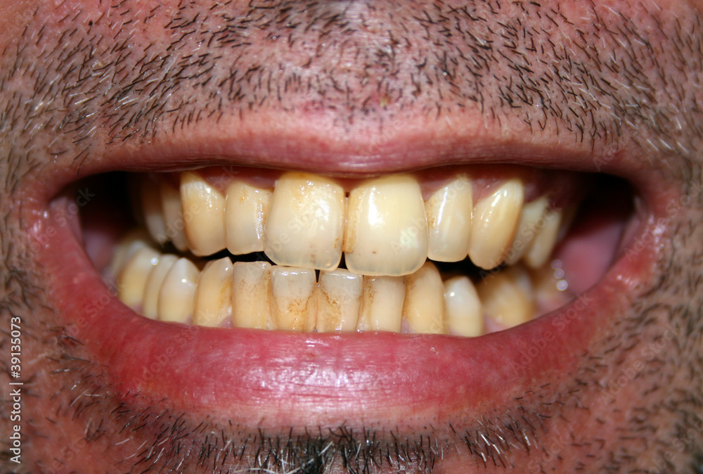 Fototapeta premium Yellow teeth