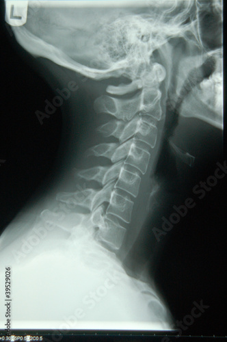 Neck X-Ray