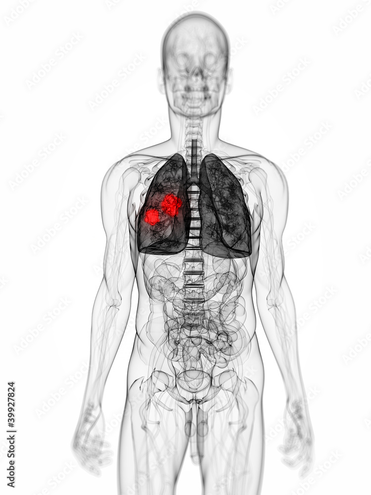 3d rendered scientific illustration of a lung tumor 3d rendered scientific illustration of a lung tumor