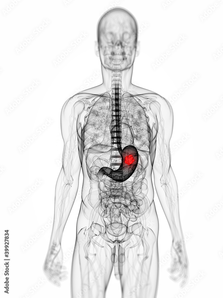Obraz premium 3d rendered scientific illustration of a stomach tumor