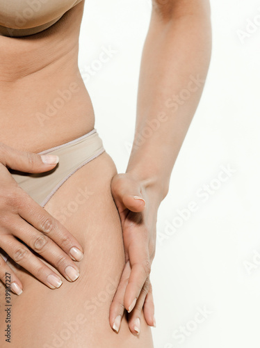 Closeup of woman showing her cellulite on the thigh