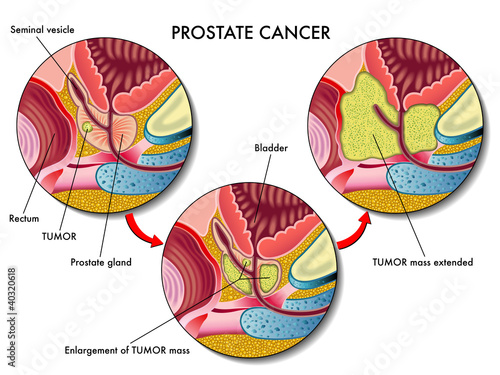 Cancro della prostata
