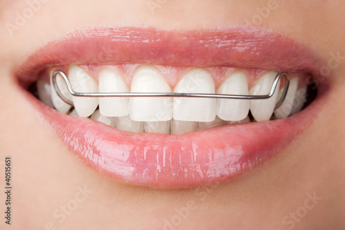 teeth with retainer