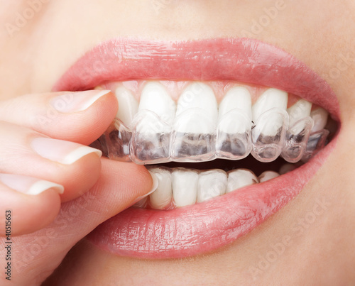Photo teeth with whitening tray