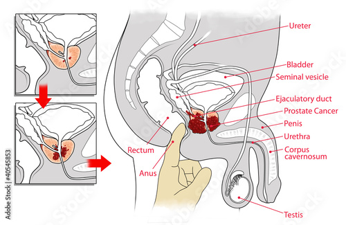  Illustration of Digital Rectal Examination (DRE) for Prostate Cancer Screening