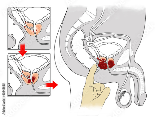 Medical illustration showing digital rectal exam of the prostate with progression of prostate condition in cross section anatomy.