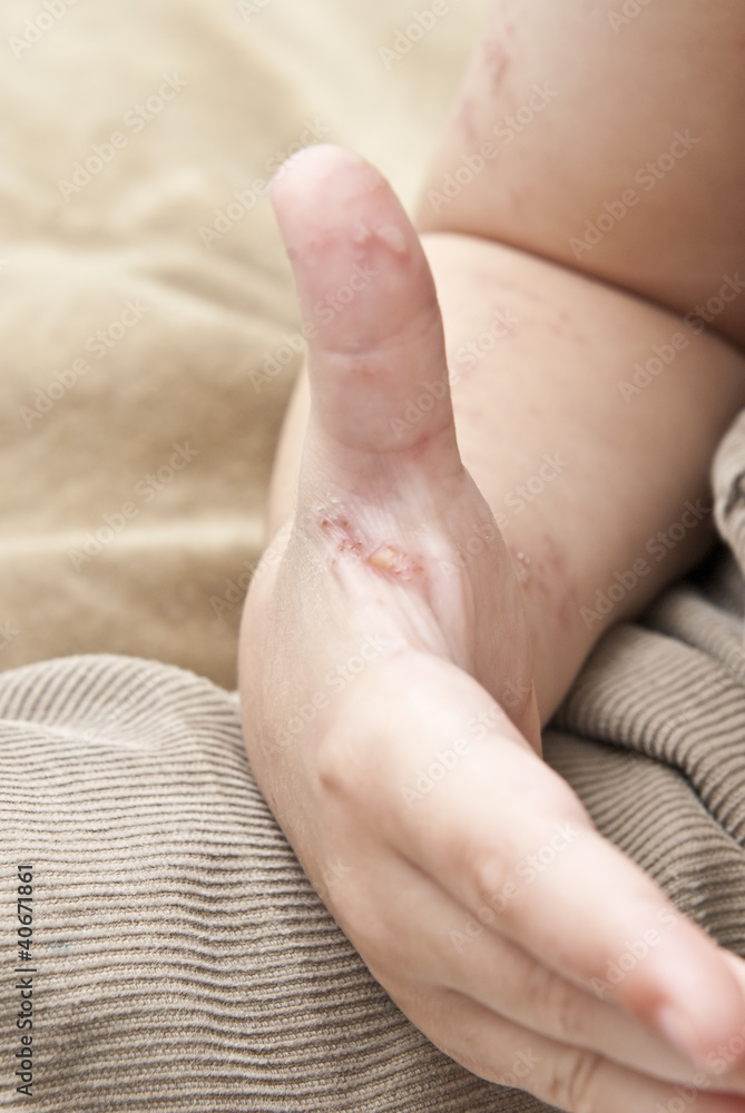 guión Empresa Estallar Ampollas del herpes zoster en la mano de un niño. foto de Stock | Adobe  Stock