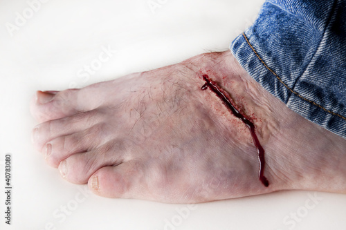 Foot Laceration