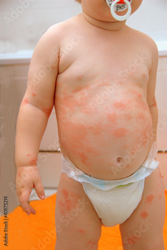 Child with neurodermitis